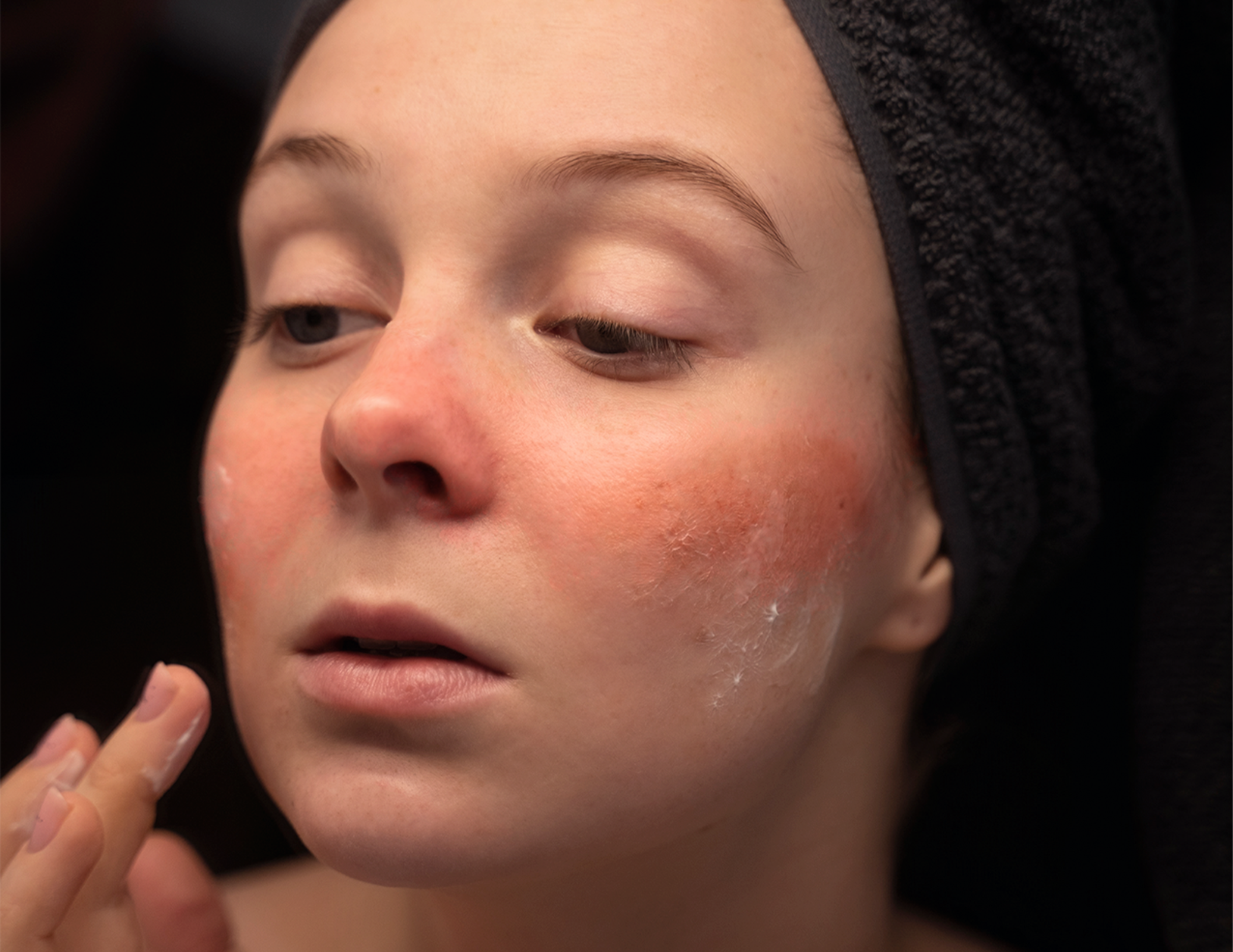 Could It Be Rosacea? Understanding the Symptoms and Care